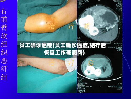 员工确诊癌症(员工确诊癌症,结疗后恢复工作被调岗)-第2张图片