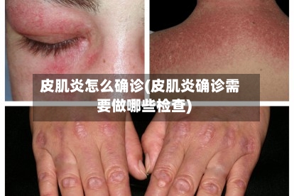皮肌炎怎么确诊(皮肌炎确诊需要做哪些检查)