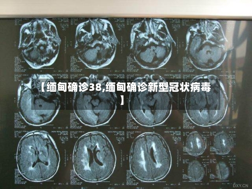 【缅甸确诊38,缅甸确诊新型冠状病毒】