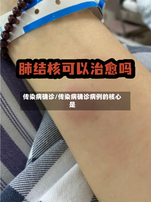 传染病确诊/传染病确诊病例的核心是-第2张图片