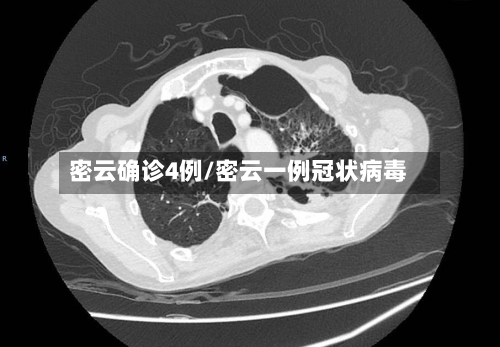 密云确诊4例/密云一例冠状病毒