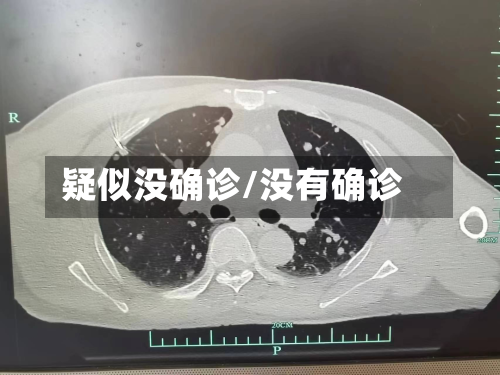 疑似没确诊/没有确诊-第3张图片