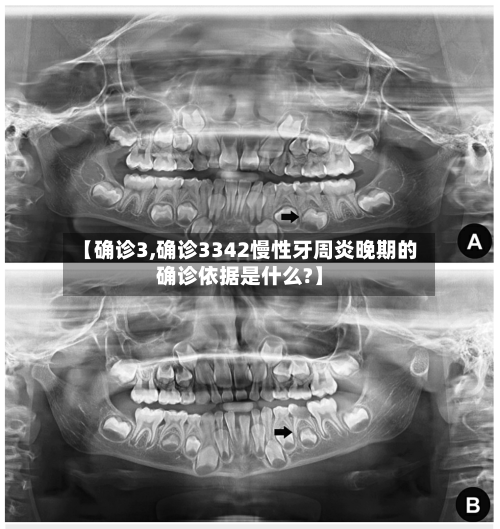 【确诊3,确诊3342慢性牙周炎晚期的确诊依据是什么?】-第2张图片