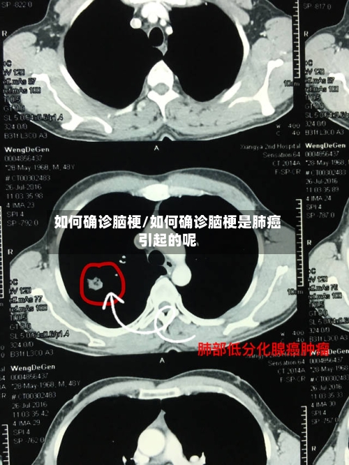 如何确诊脑梗/如何确诊脑梗是肺癌引起的呢-第2张图片