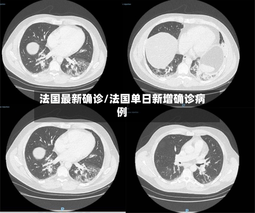 法国最新确诊/法国单日新增确诊病例