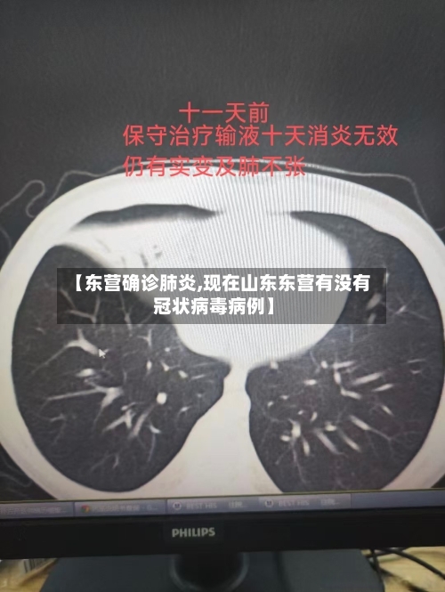 【东营确诊肺炎,现在山东东营有没有冠状病毒病例】-第3张图片