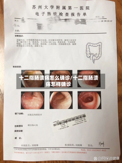 十二指肠溃疡怎么确诊/十二指肠溃疡怎样确诊-第3张图片