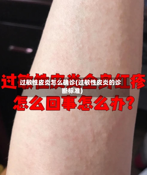 过敏性皮炎怎么确诊(过敏性皮炎的诊断标准)