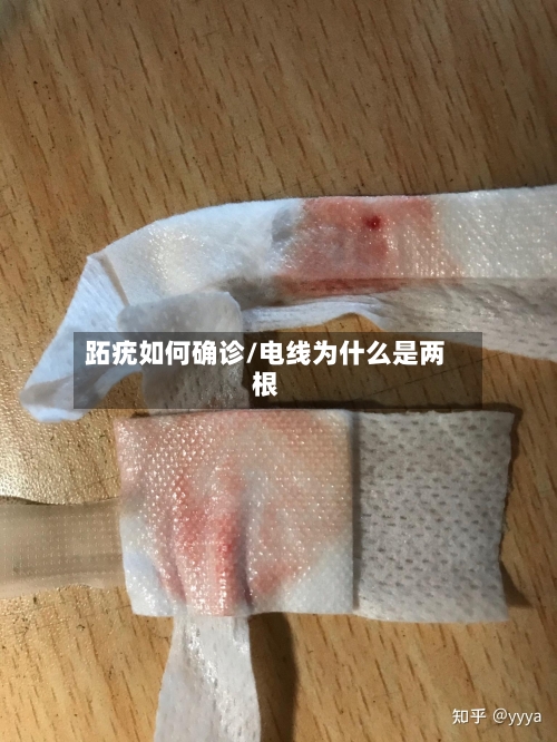 跖疣如何确诊/电线为什么是两根